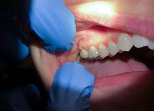 Best Emergency Root Canal Treatment in Markle, IN